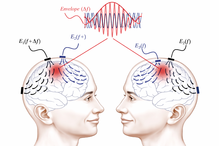 山海医疗里程碑式突破！时间干涉刺激（tTIS）技术突破深脑禁区，重塑神经调控未来